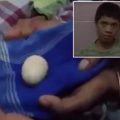 印尼男童会“生蛋” 两年排出20颗蛋令人惊奇