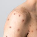 美国专家称猴痘疫情在美国有失控风险